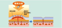 抗VEGF療法