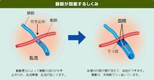 網膜静脈閉塞症