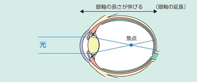 強度近視