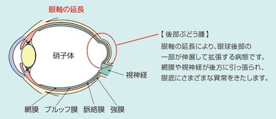 強度近視