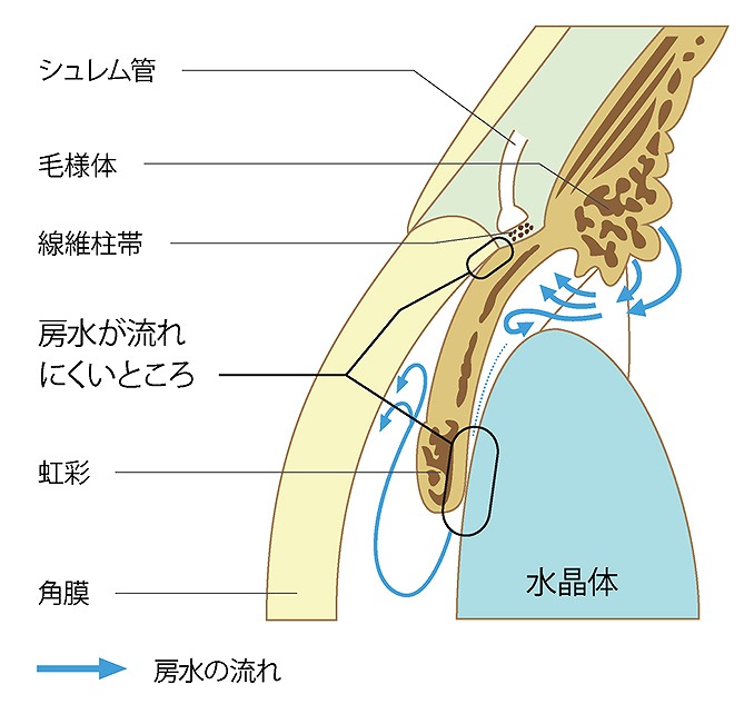 原発閉塞隅角緑内障