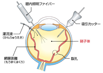 日帰り網膜・硝子体手術